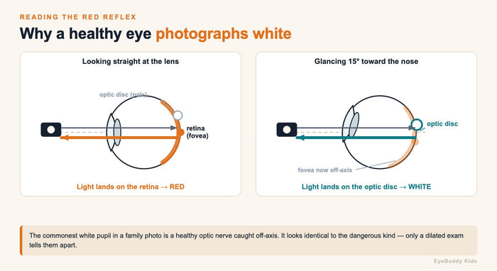 A White Pupil in a Photo Is Usually Not Cancer. Get It Checked Anyway.
